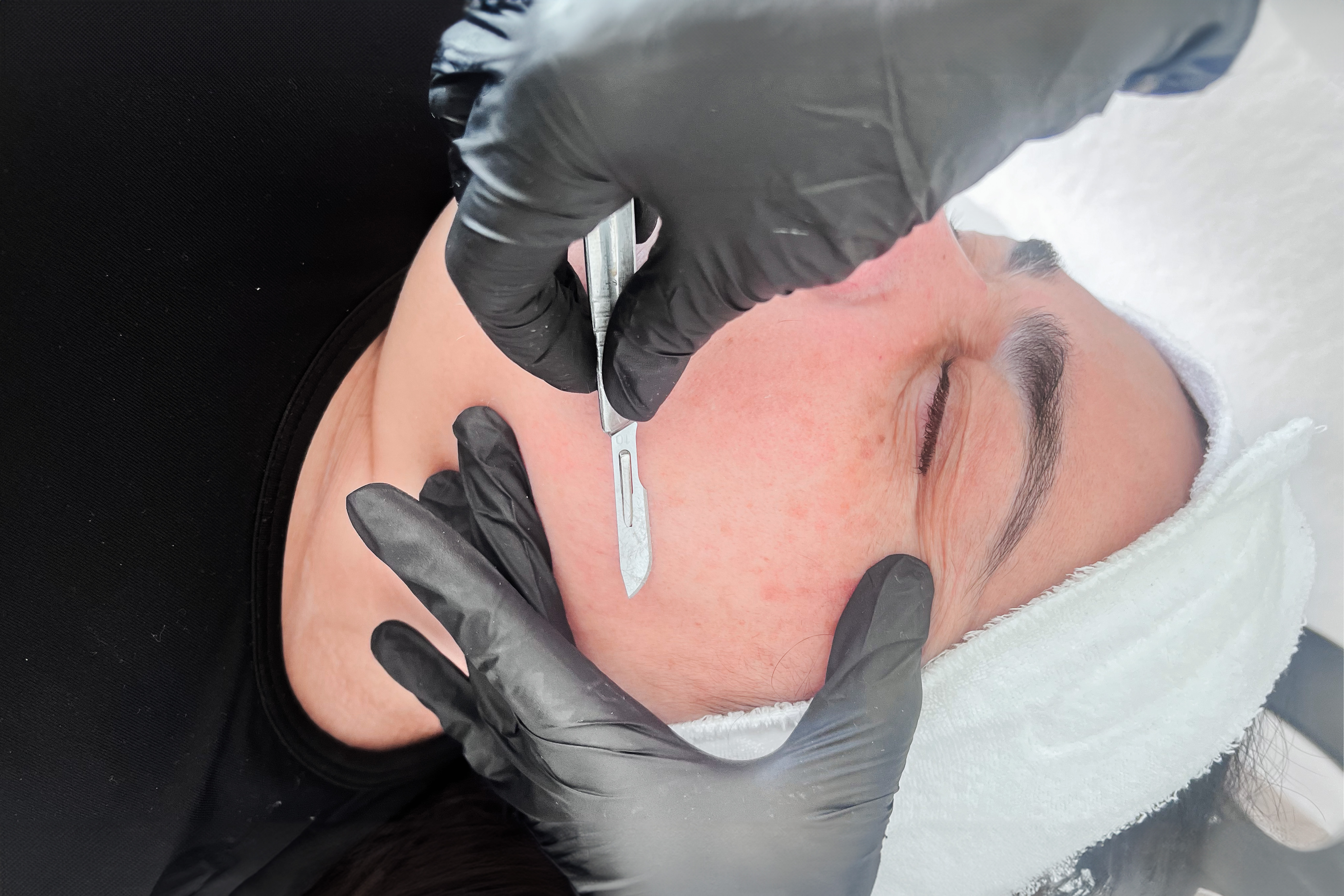 Higiene con dermaplaning