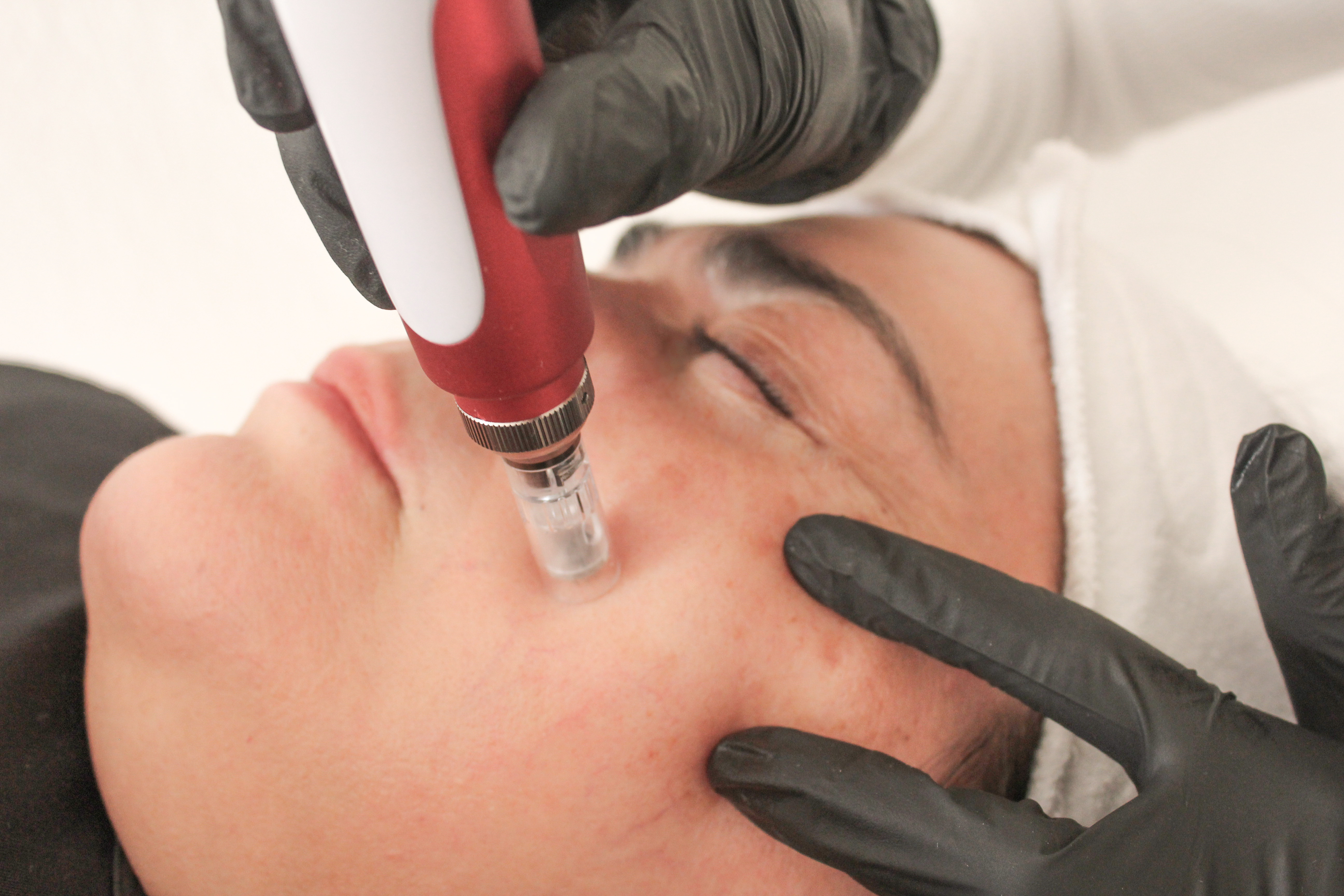 Microneedling